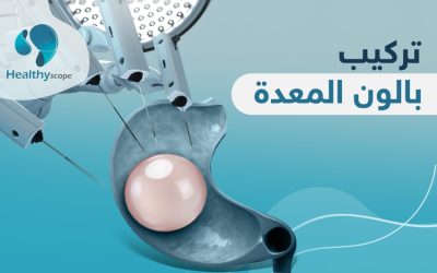 عملية تركيب بالون المعدة…الخيار الأفضل لإنقاص الوزن الزائد